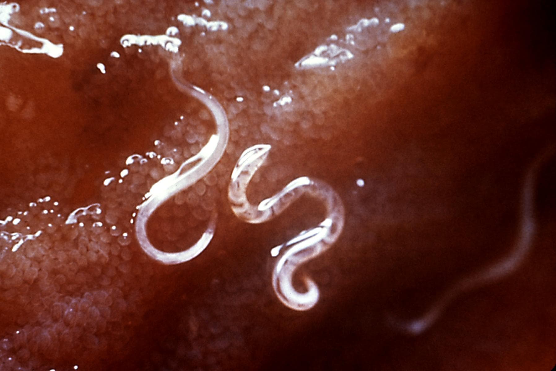 Hookworm and allergies