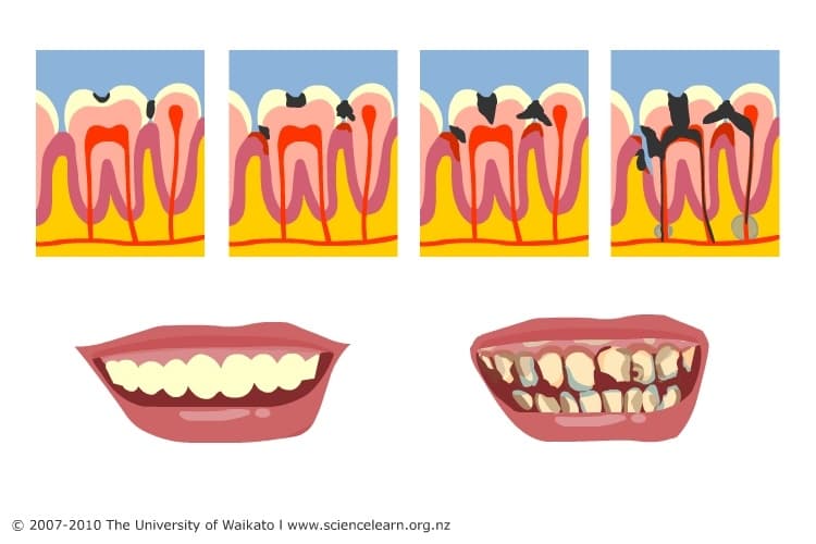 Hamilton’s fluoride debate