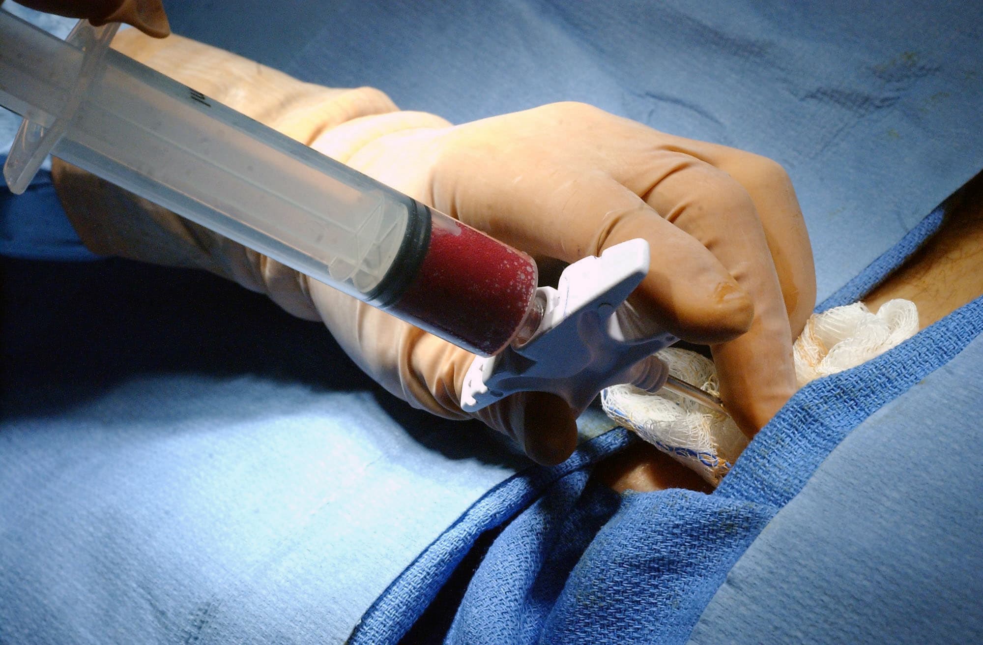 Bone marrow transplantation