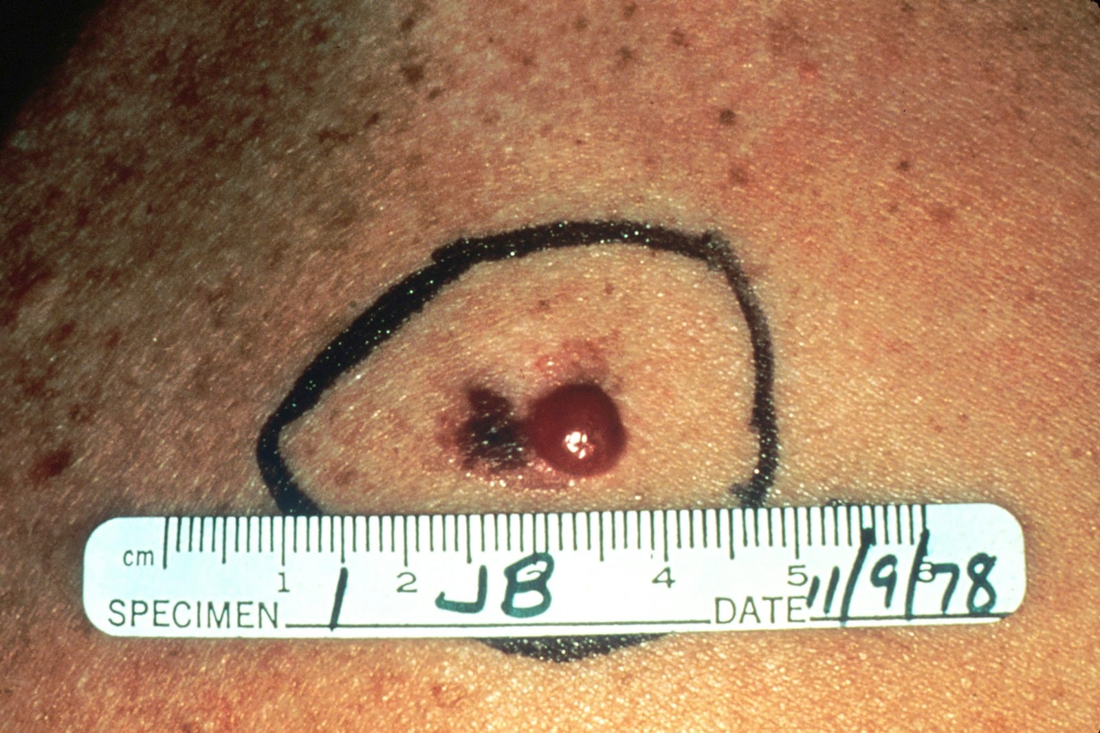 An advanced melanoma circled with pen and rule measurement.