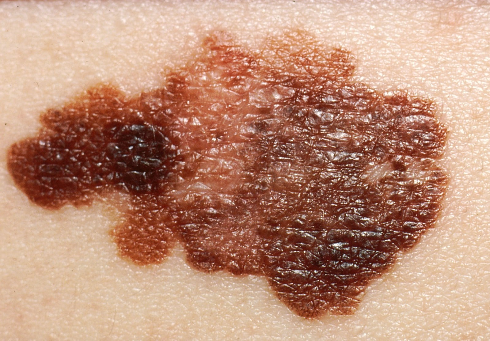 Close up of A typical melanoma showing ABCDE features.